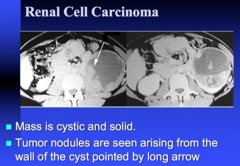 cystic RCC lesion on CT