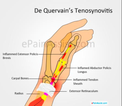 de Quervain syndrome