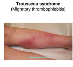 Define trousseau syndrome