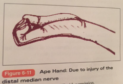 Deformity of Median Nerve Laceration?