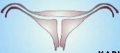 DES uterus: defect, description, cause, risks