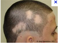 describe the appearance of alopecia areata.