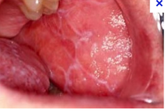 describe the appearance of lichen planus in the mouth.