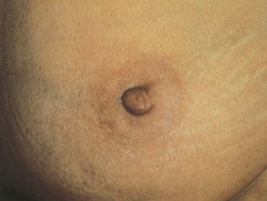 Deviation in nipple pointing