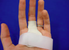 Digital stenosing tenosynovitis (trigger finger) OT tx