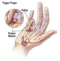 Digital stenosing tenosynovitis (trigger finger)