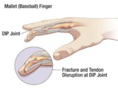 Distal Phalanx Fracture:  *Most common finger fracture  -May result in ___1___, which involves terminal extensor tendon