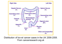 Distribution of bowel cancer cases in the UK 2006-2008