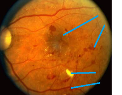 DM- retinopathy