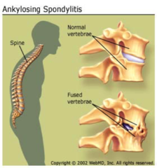 Does Ankylosing spondylitis affect the ligaments and tendons?