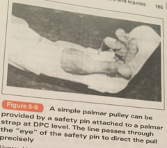 Early Mobilization Protocols for Flexor Tendons:  ___1___: Passive flexion using rubber band traction & active extension to the hood of the splint