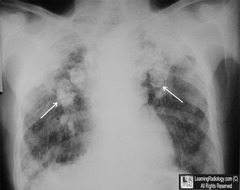 egg shell calcifications