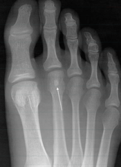 Either an accessory sesamoid or a bone island on the 2nd toe. It really doesn't matter which.   The other 2 on the first toe are both sesamoid bones.