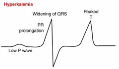 EKG strip of hyperkalemia