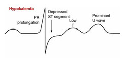EKG strip of hypokalemia