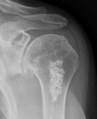 Enchondroma (Notice popcorn calcification)  This patient has an osteophyte on the inferior of the humeral head. Probably why they came into get an xray.