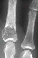 Enchondroma (Popcorn calficiation and path fracture)