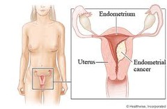 Endometrial Cancer