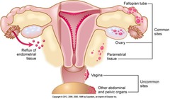 Endometriosis (Cont'd)