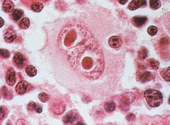 Epstein-Barr Virus Cancer   Hodgkin's Disease  Reed-Sternberg cell -appearance