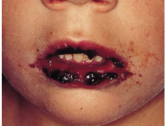 Erythema Multiforme on lips