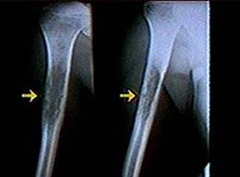 Ewing Sarcoma