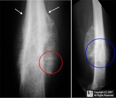 Ewing Sarcoma Medical Management