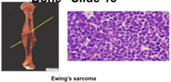 Ewing Sarcoma Signs and Symptoms