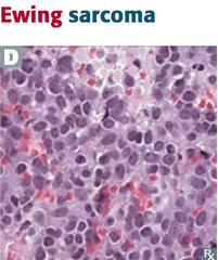 Ewing Sarcoma What is it