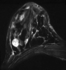 expected appearance of fibroadenoma on MRI