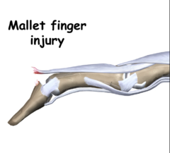 extensor tendon injuries: Zone 1 & 2