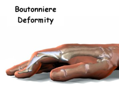 extensor tendon injuries: Zone 3 & 4