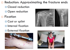Facilitating Fracture Healing