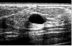 features of a benign simple cyst on ultrasound