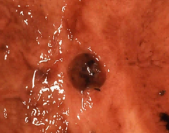 Features of benign gastric ulcers?