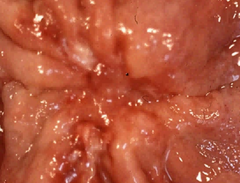 Features of cancerous gastric ulcers?