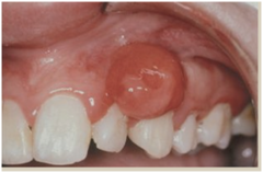 Fibroma