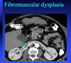 fibromuscular dysplasia is a cause of HTN in what patient population?