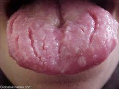 Fissured tongue