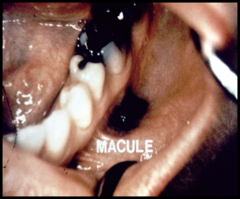 flat lesion of abnormal color