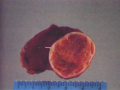 Folicular adenoma-gross