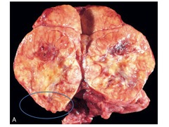 Follicular carcinoma gross features