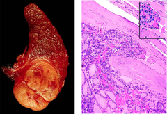 follicular carcinoma