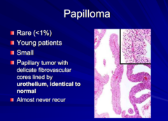 Following slides are from prework only - lower priority  What are papillomas? Who do they usually affect?