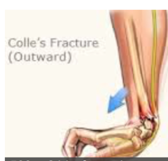 Fracture of the distal radius with DORSAL displacement