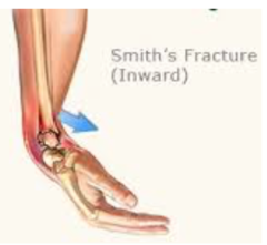 Fracture of the distal radius with VOLAR displacement