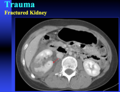 fractured kidney on CT  what contrast phase is used to see a fractured kidney on CT?