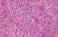 Giant cell tumor of bone (osteoclastoma) - osteoclastic giant cells mixed with mononuclear histiocytes.  Benign  The ends of long bones and the pelvis.