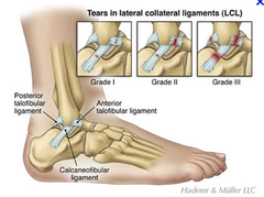 Grades of ankle sprains and descriptions