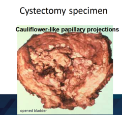 Tumors of the Kidney and Urinary Tract | StudyHippo.com